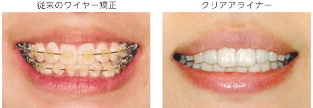 クリアアライナー