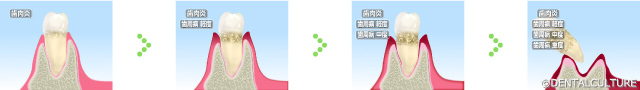 歯周病の発生と進行