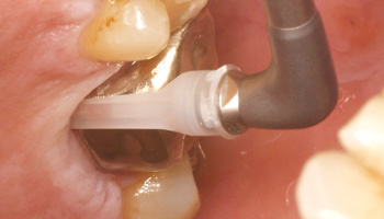 歯肉縁下ケア